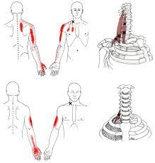 Scalenes trigger points