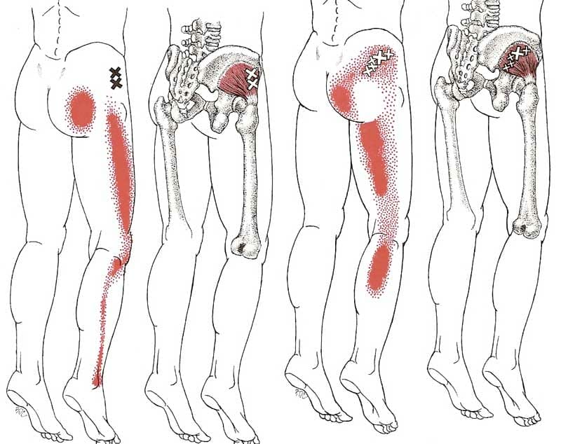Trigger Point Therapy for Sciatic Pain
